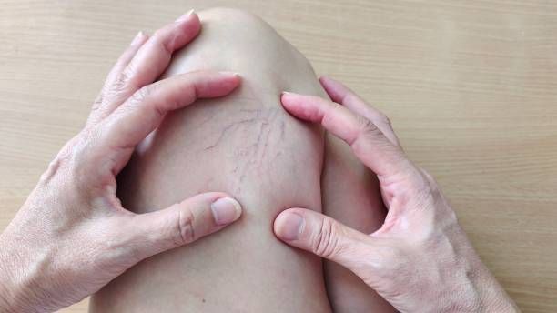 лечение на разширени вени - 93206 разновидности