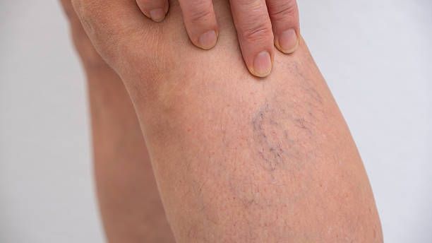 лечение на разширени вени - 31831 разновидности